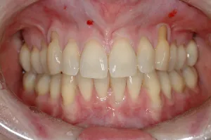 Connective Tissue Graft case study