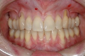 Connective Tissue Graft case study