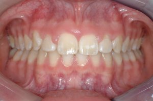 Esthetic Crown Lengthening case study