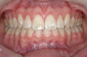 Esthetic Crown Lengthening case study