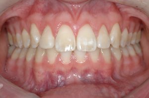 Esthetic Crown Lengthening case study