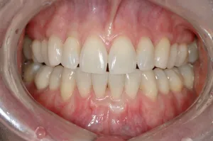 Connective Tissue Graft case study