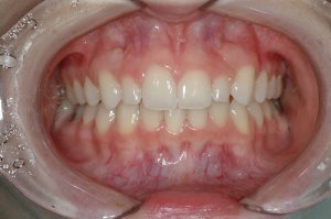 Esthetic Crown Lengthening case study