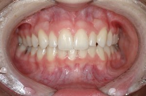 Esthetic Crown Lengthening case study