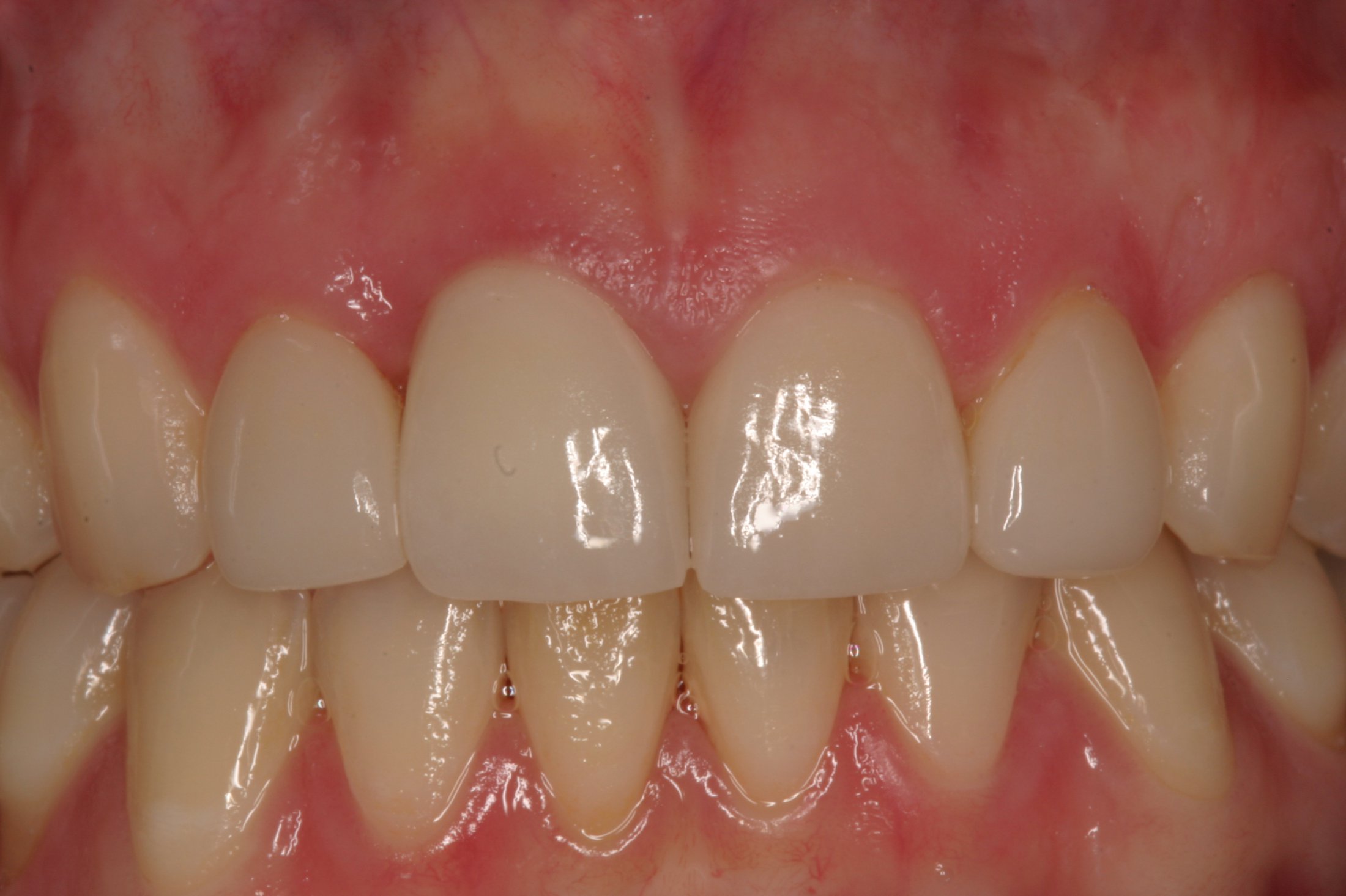 Dental Implants case study