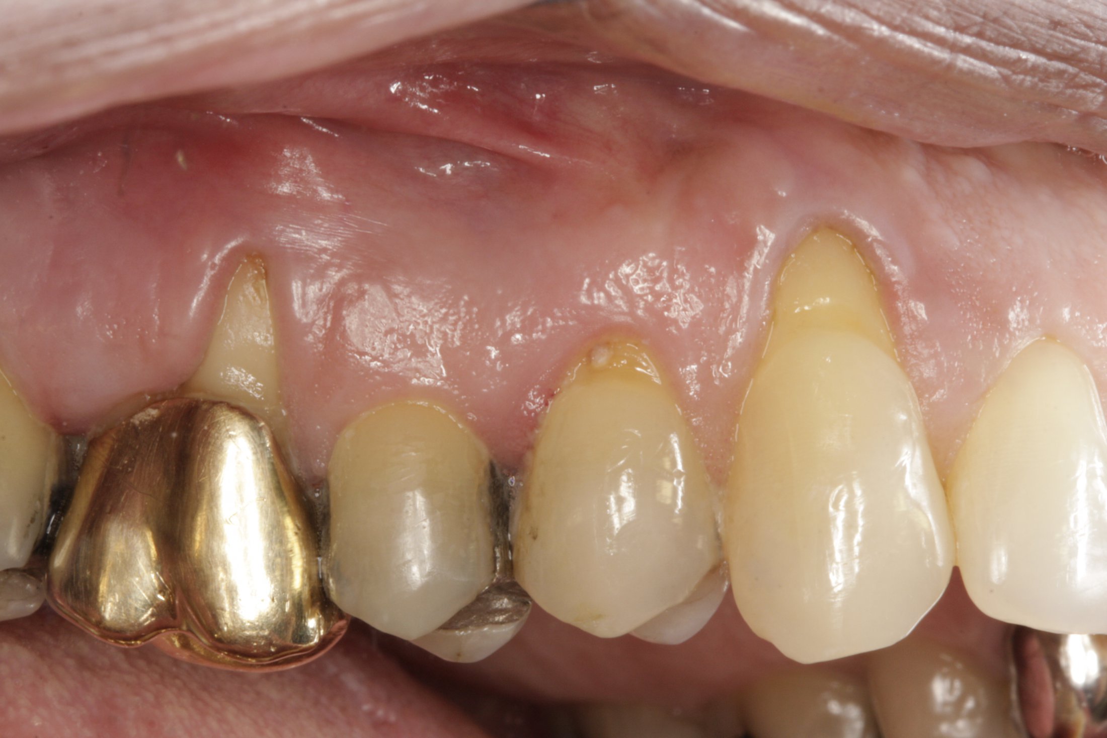 Connective Tissue Graft case study