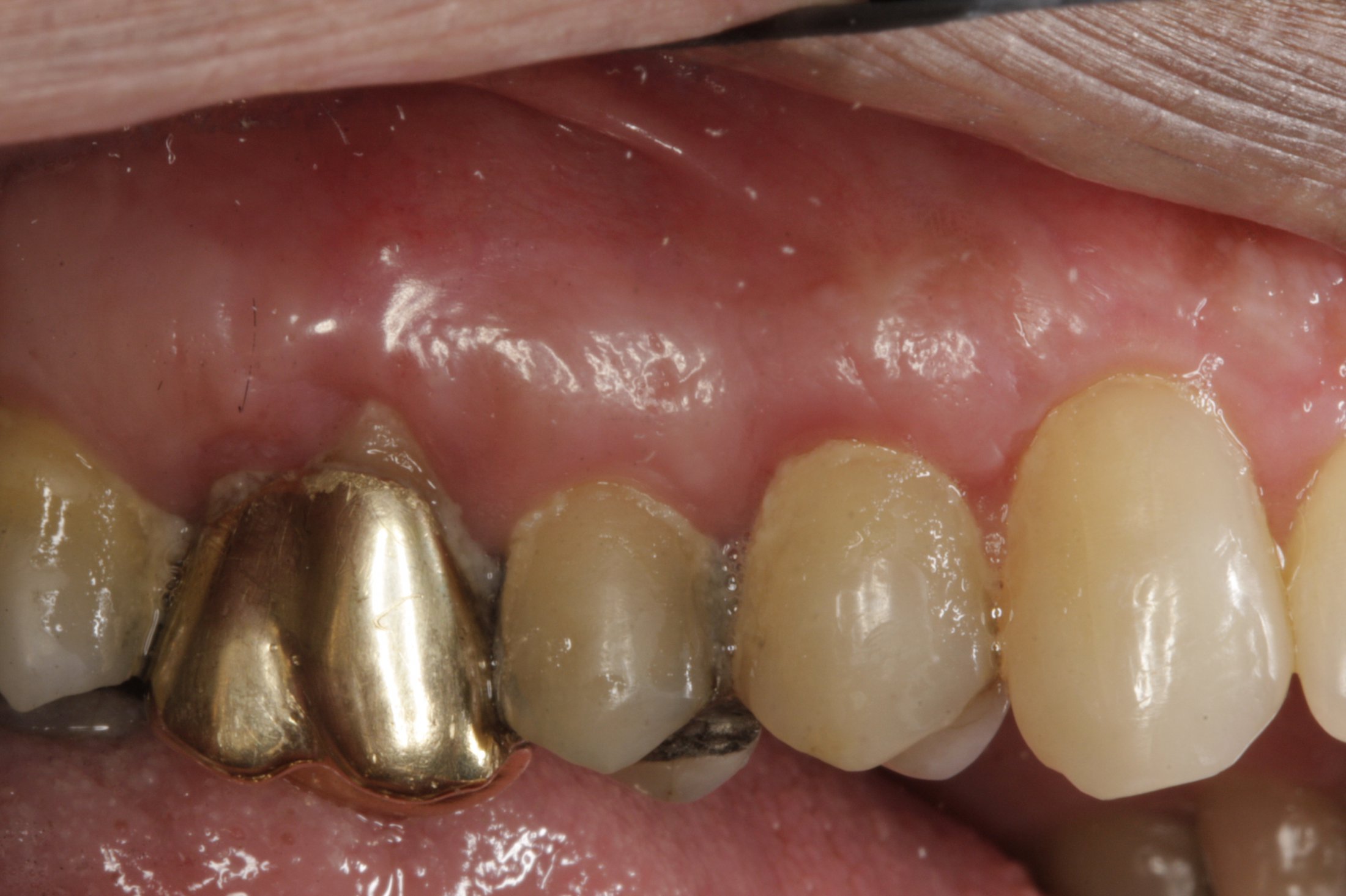 Connective Tissue Graft case study