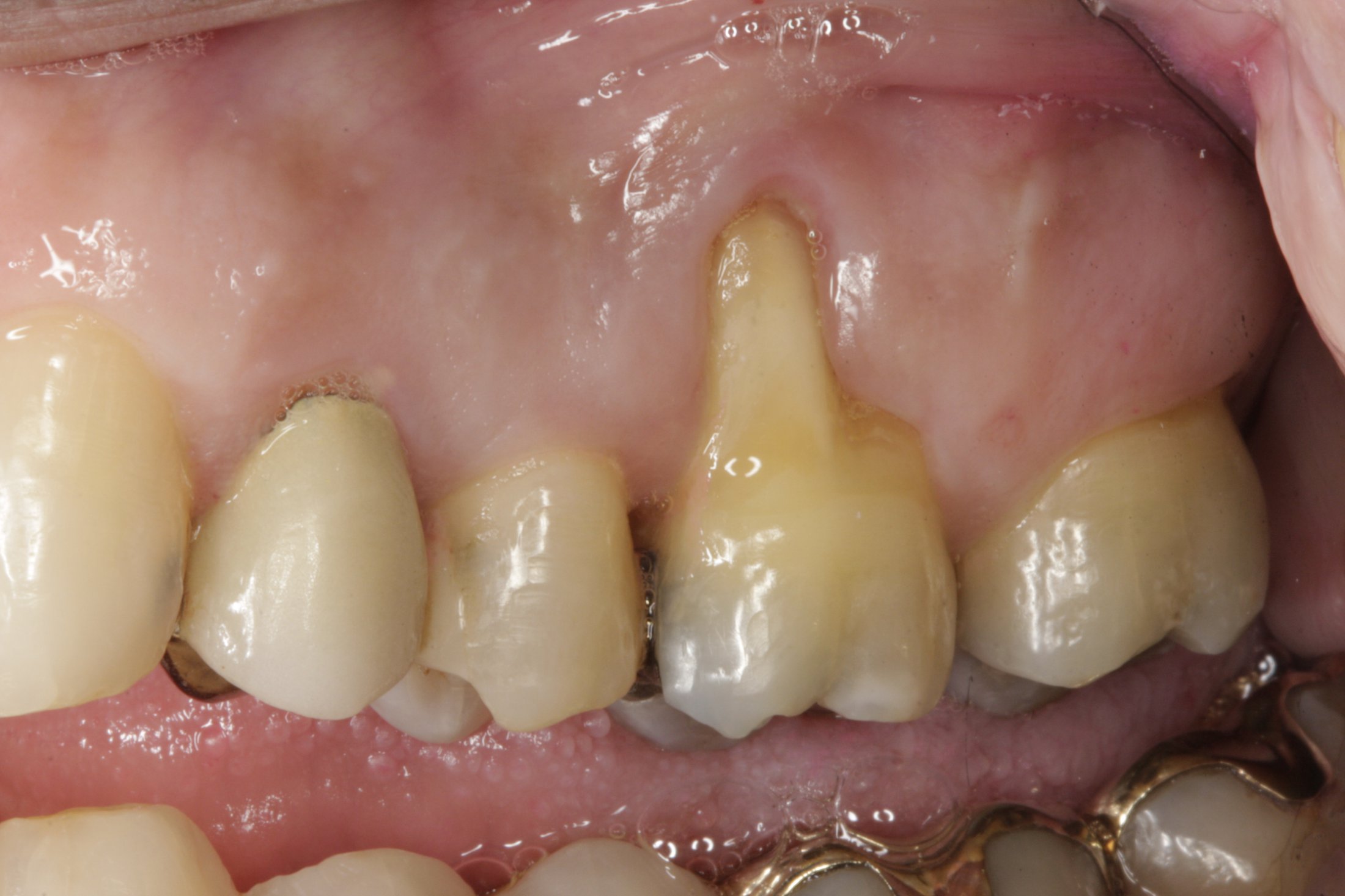 Connective Tissue Graft case study
