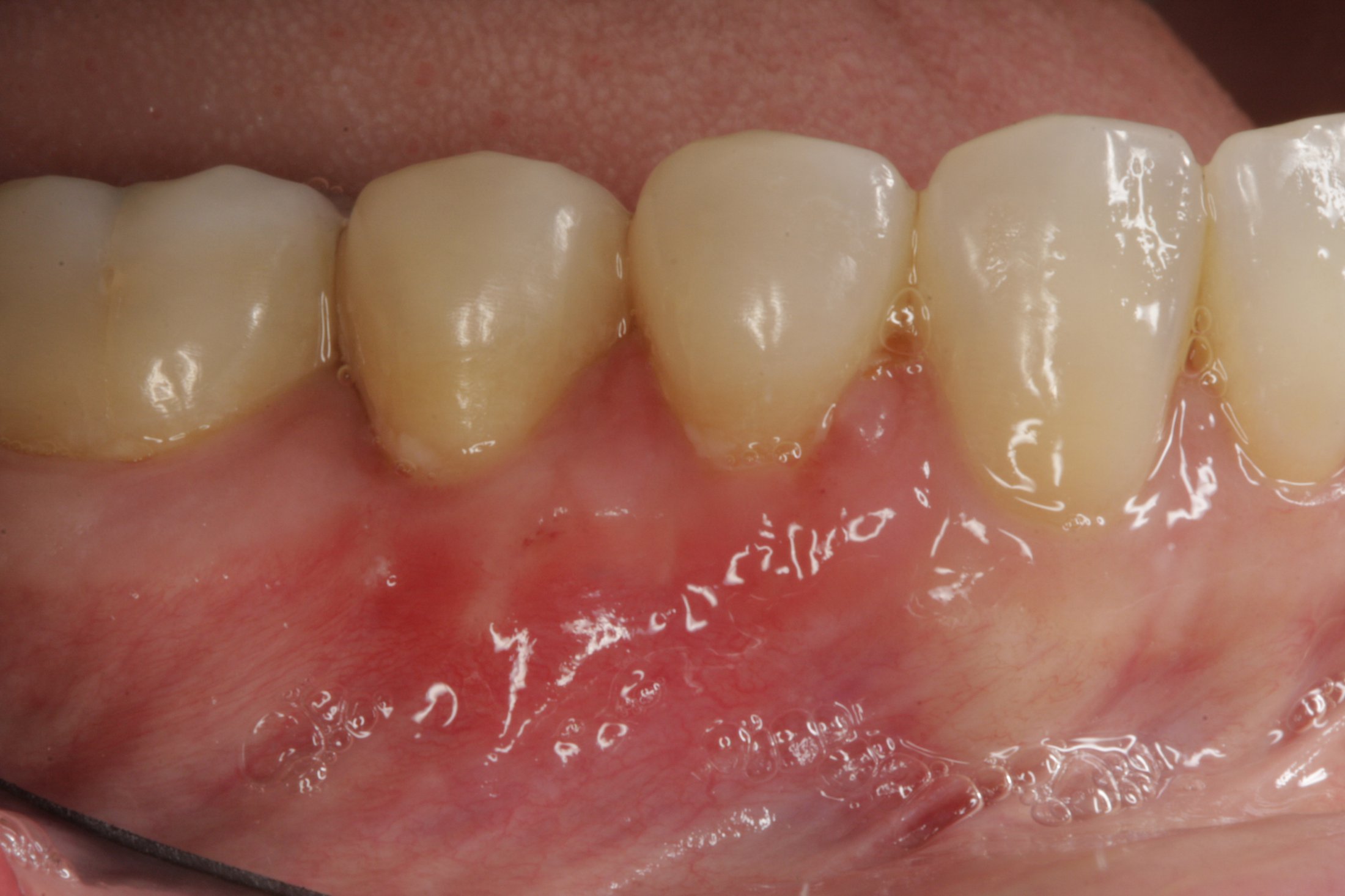 Allograft case study