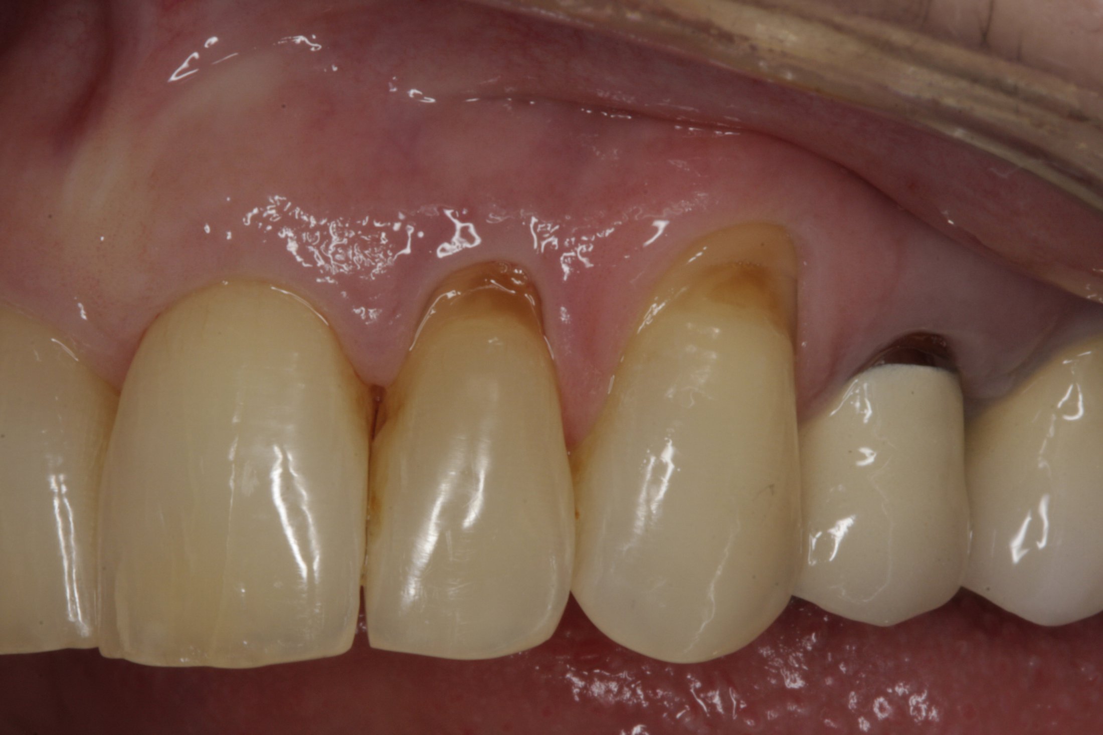 Allograft case study