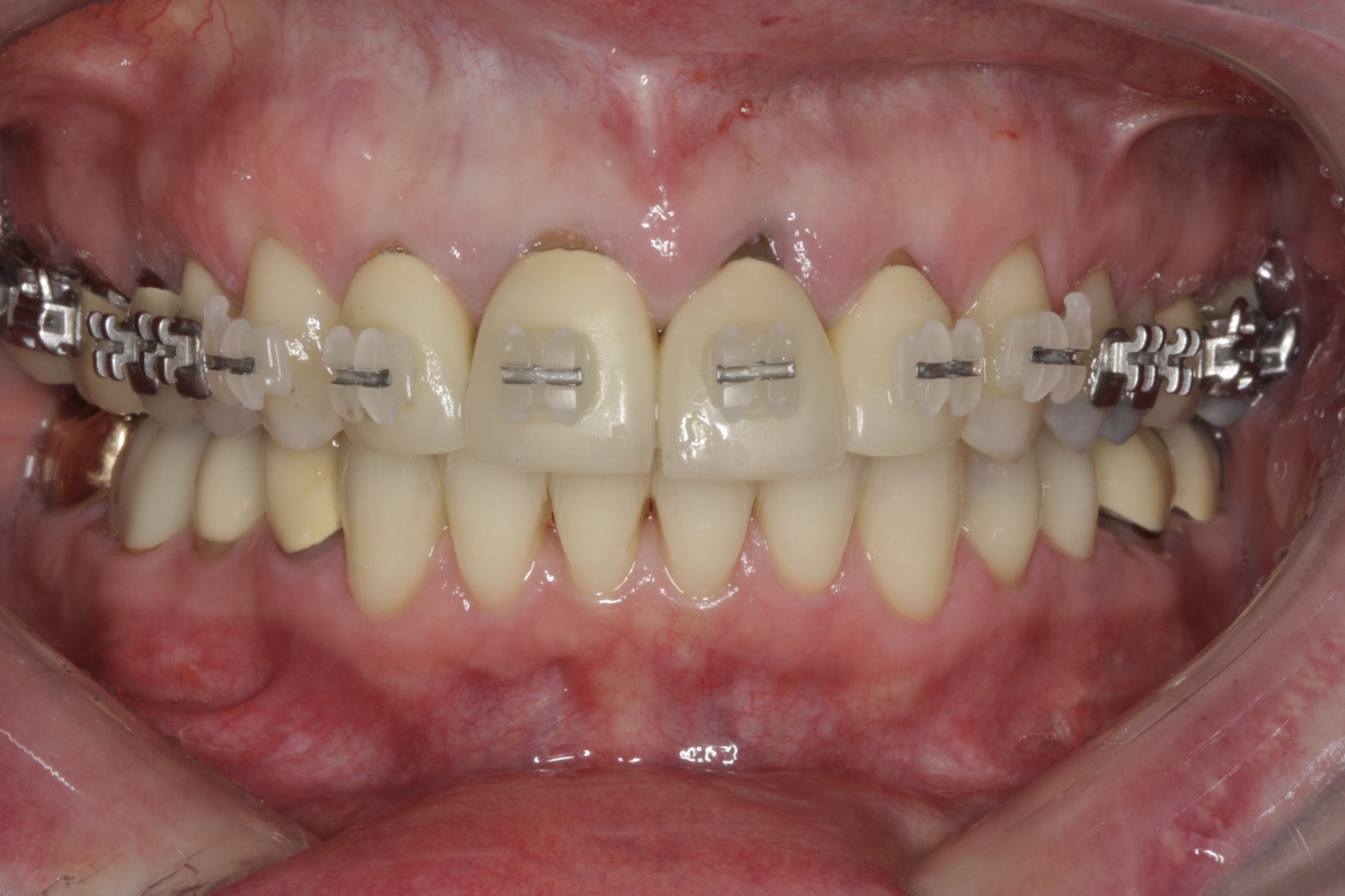 Dental Implants case study