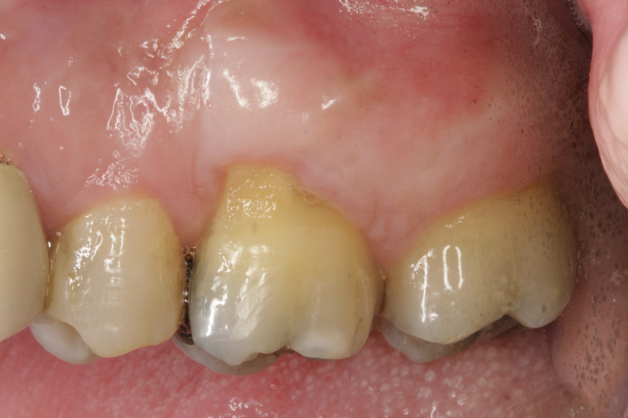 Connective Tissue Graft case study