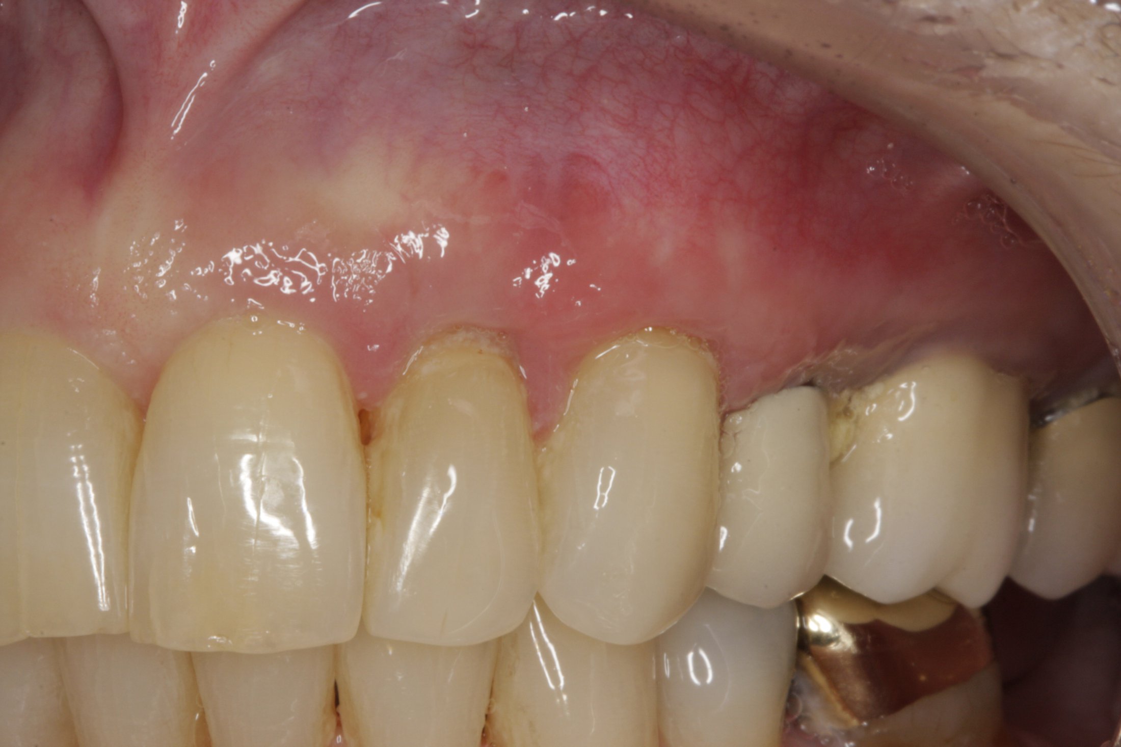 Allograft case study