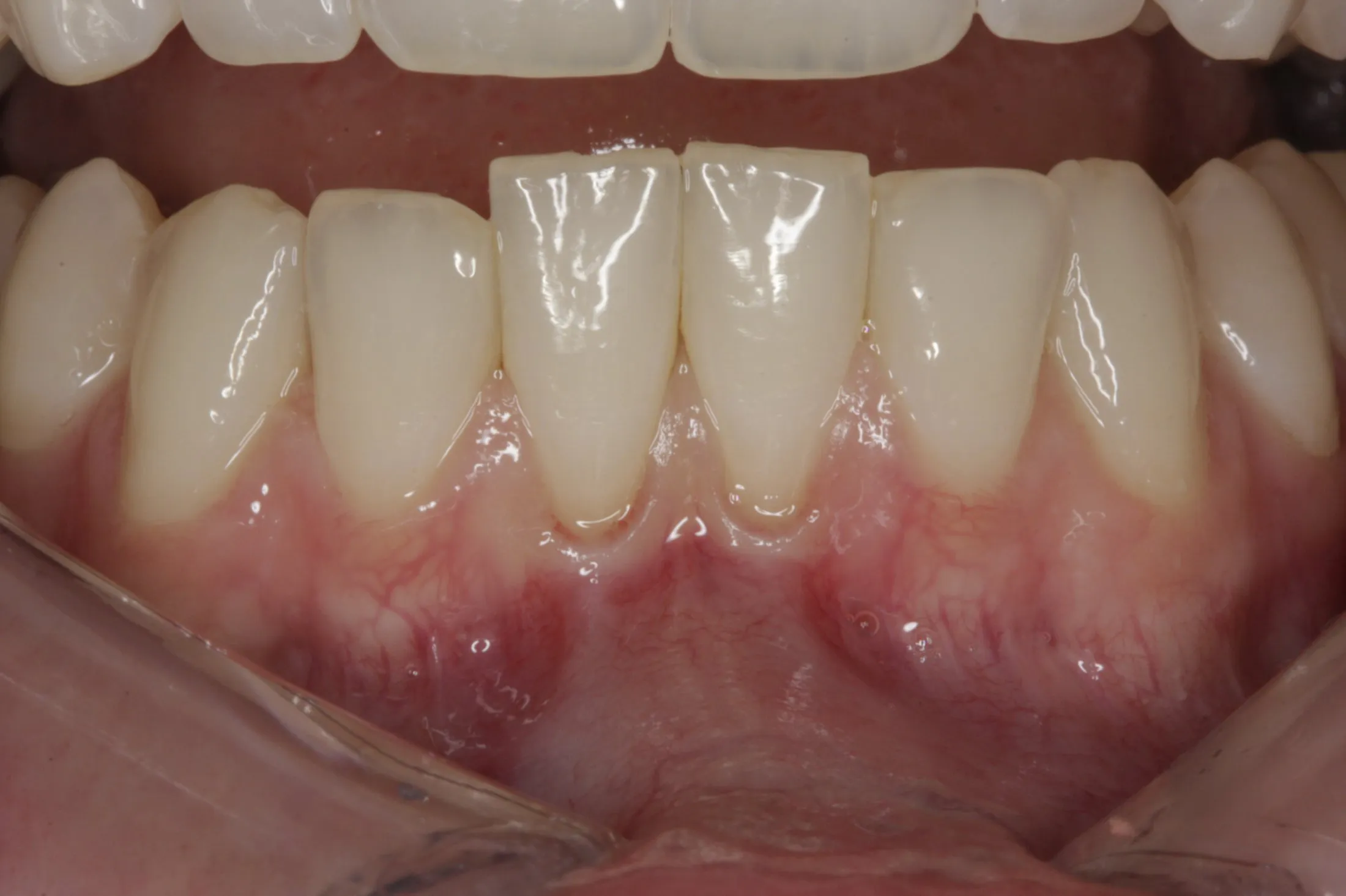 Free Gingival Graft case study
