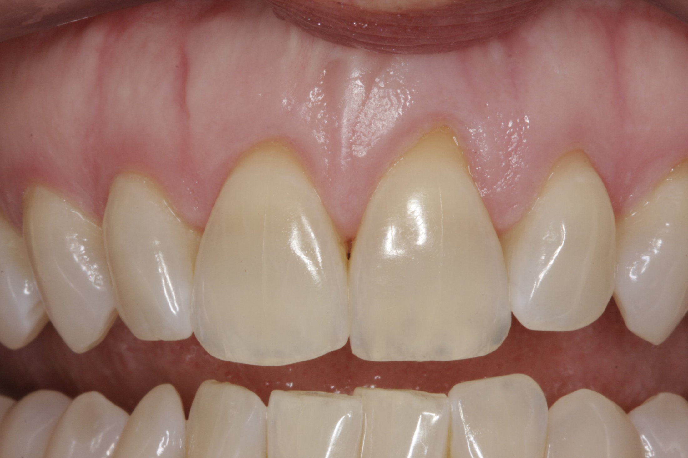 Allograft case study