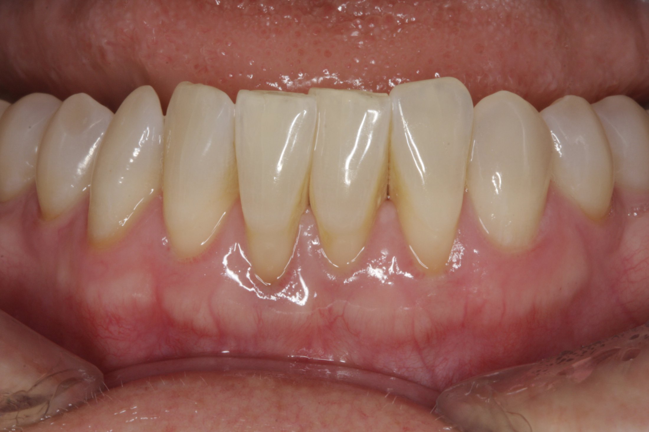 Allograft case study