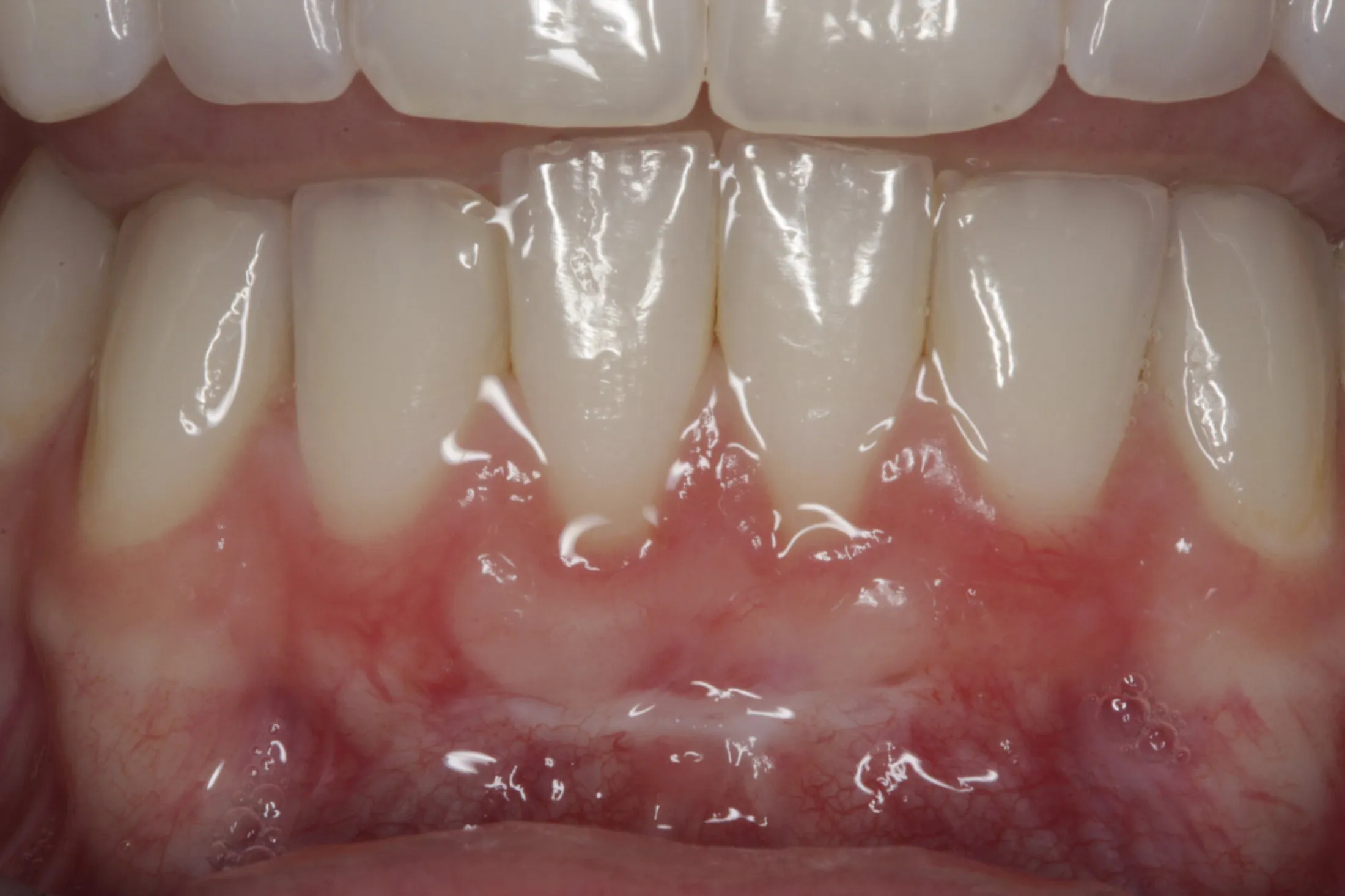Free Gingival Graft case study