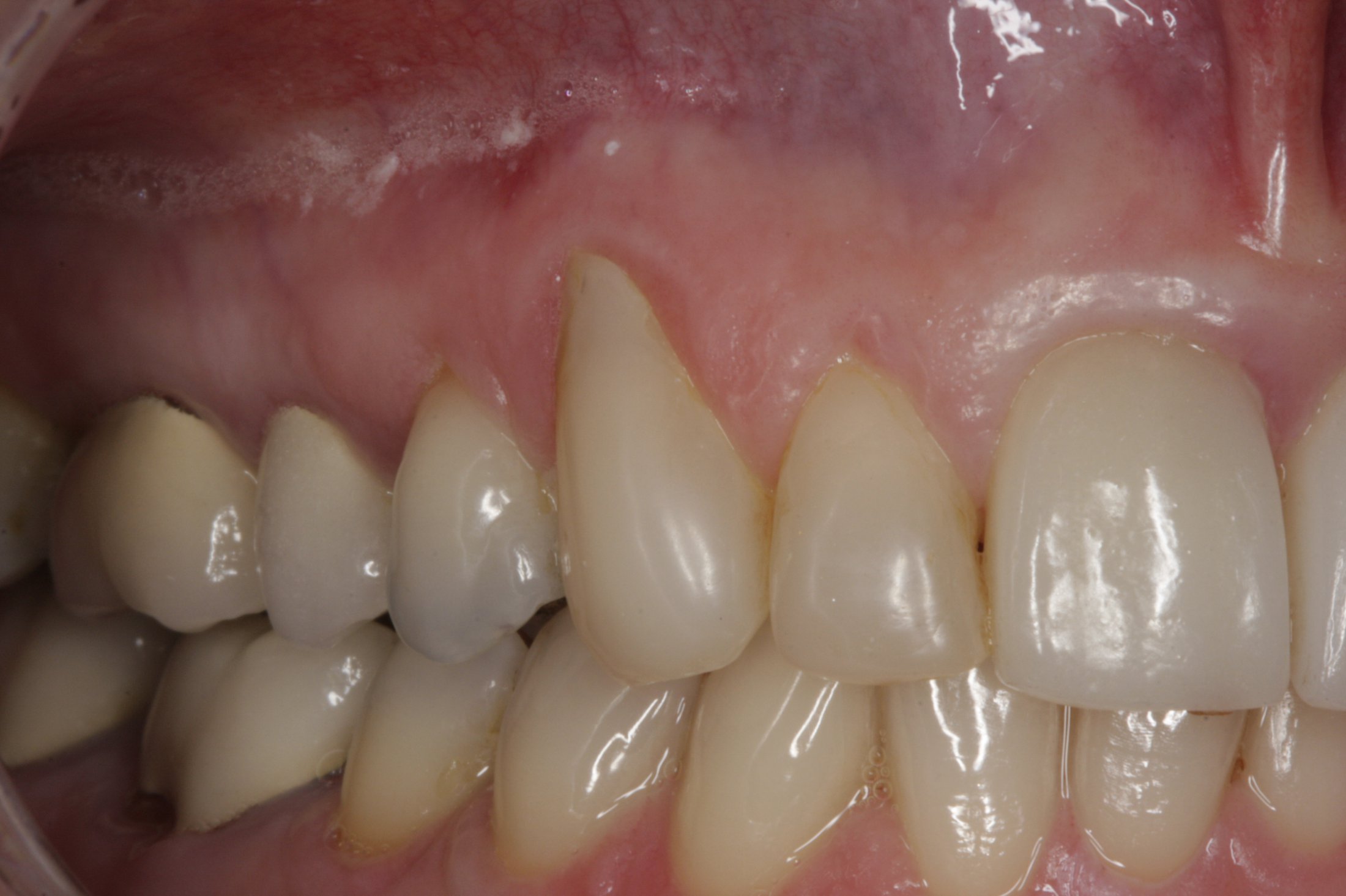 Allograft case study