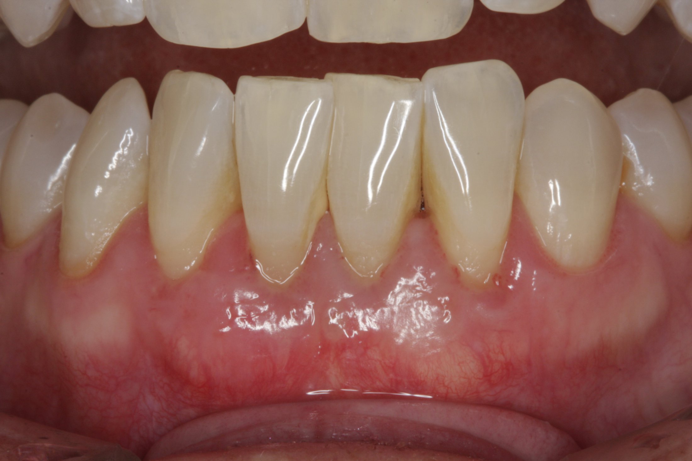 Allograft case study