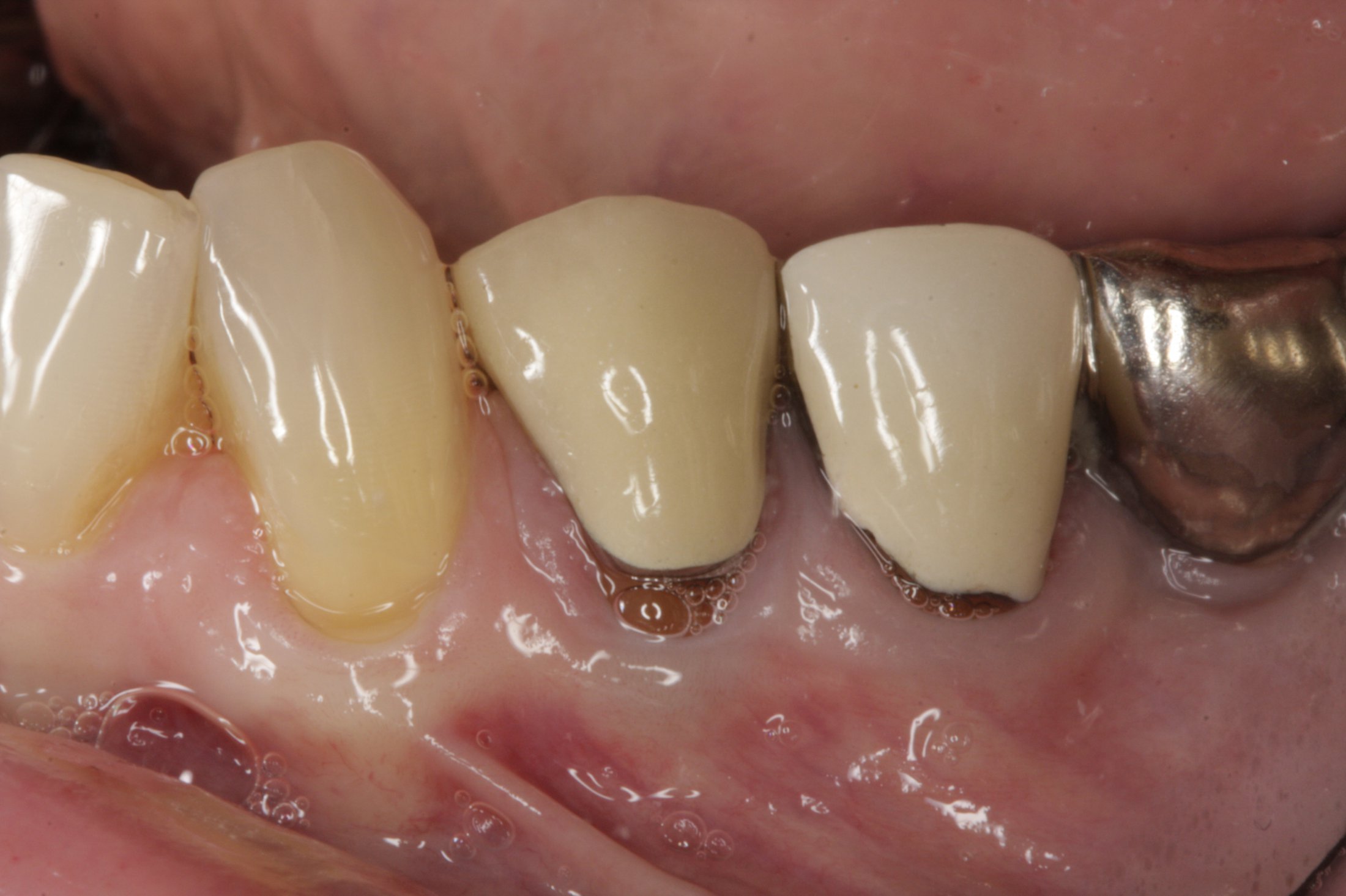 Allograft case study