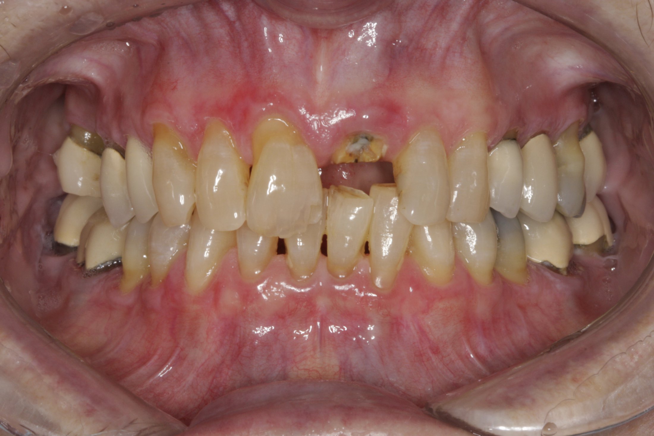 Dental Implants case study