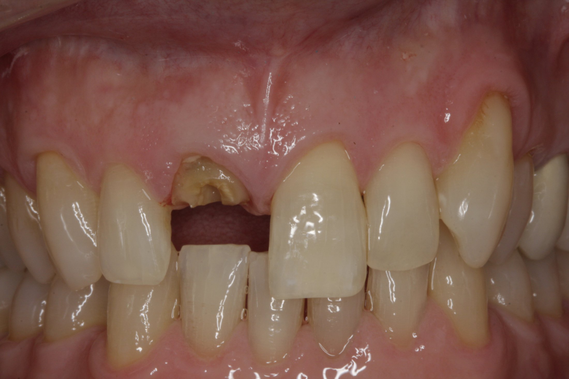 Dental Implants case study