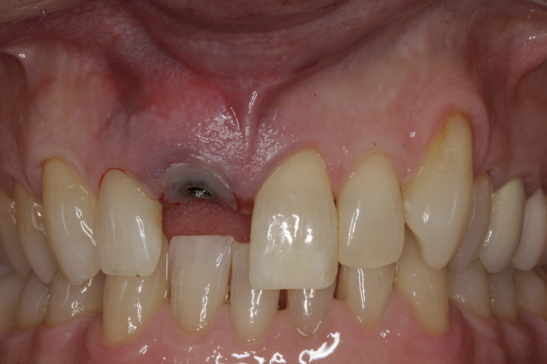 Dental Implants case study