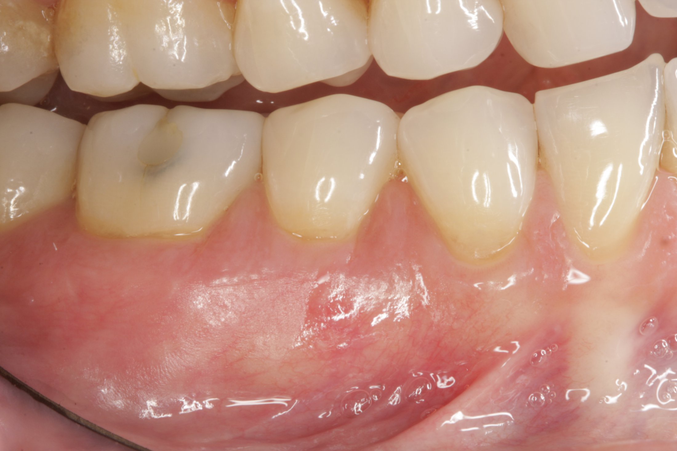 Allograft case study