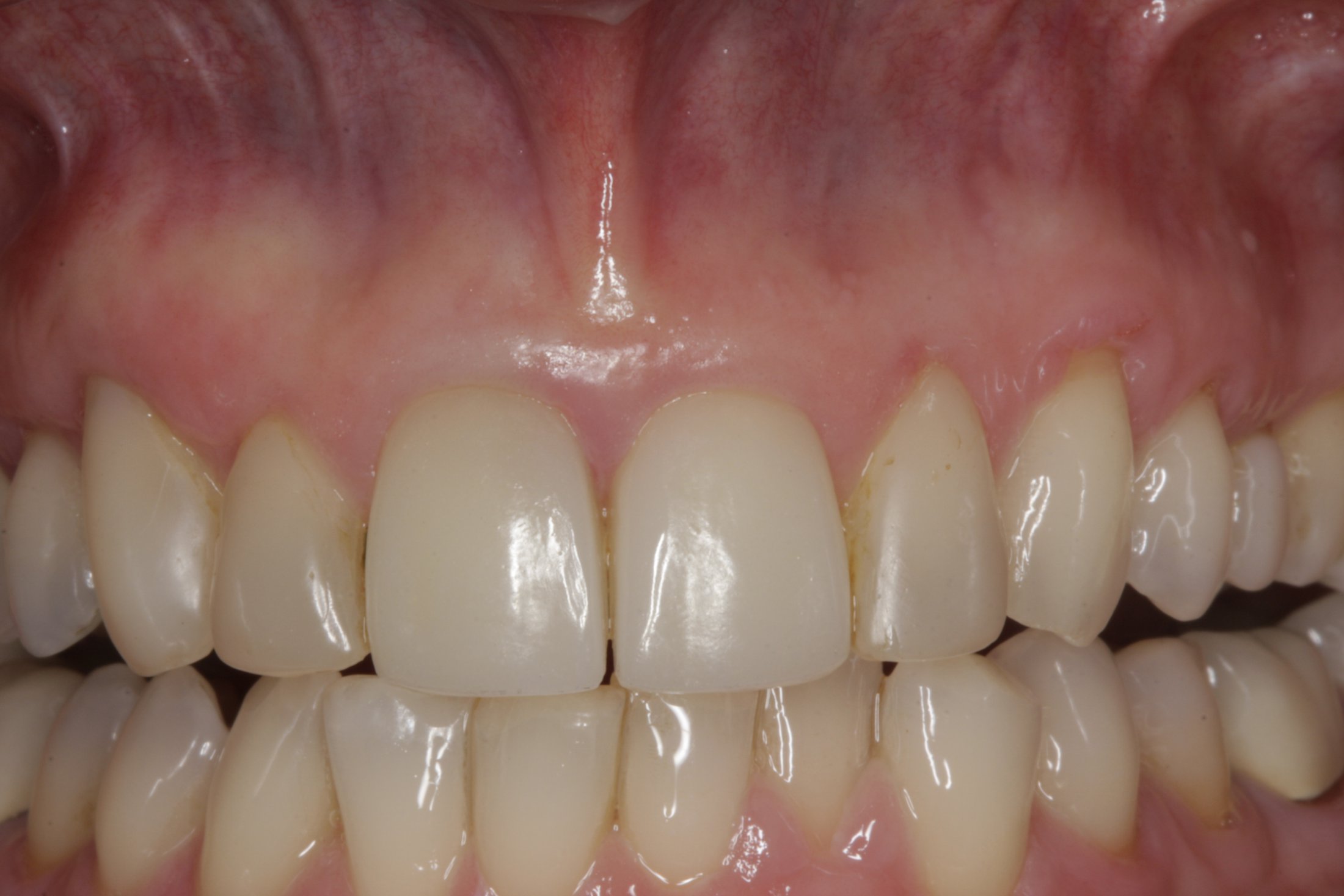 Allograft case study