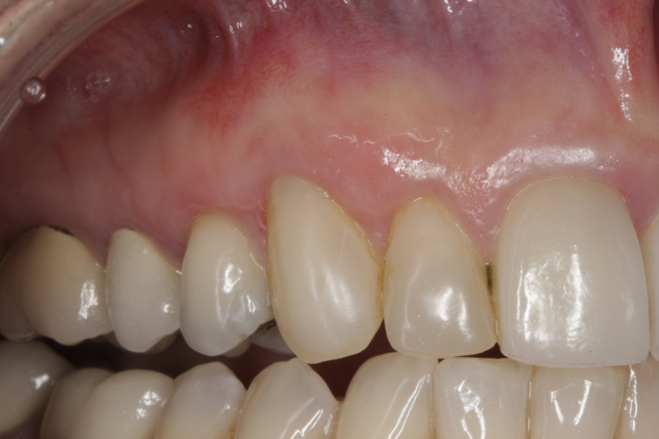 Allograft case study