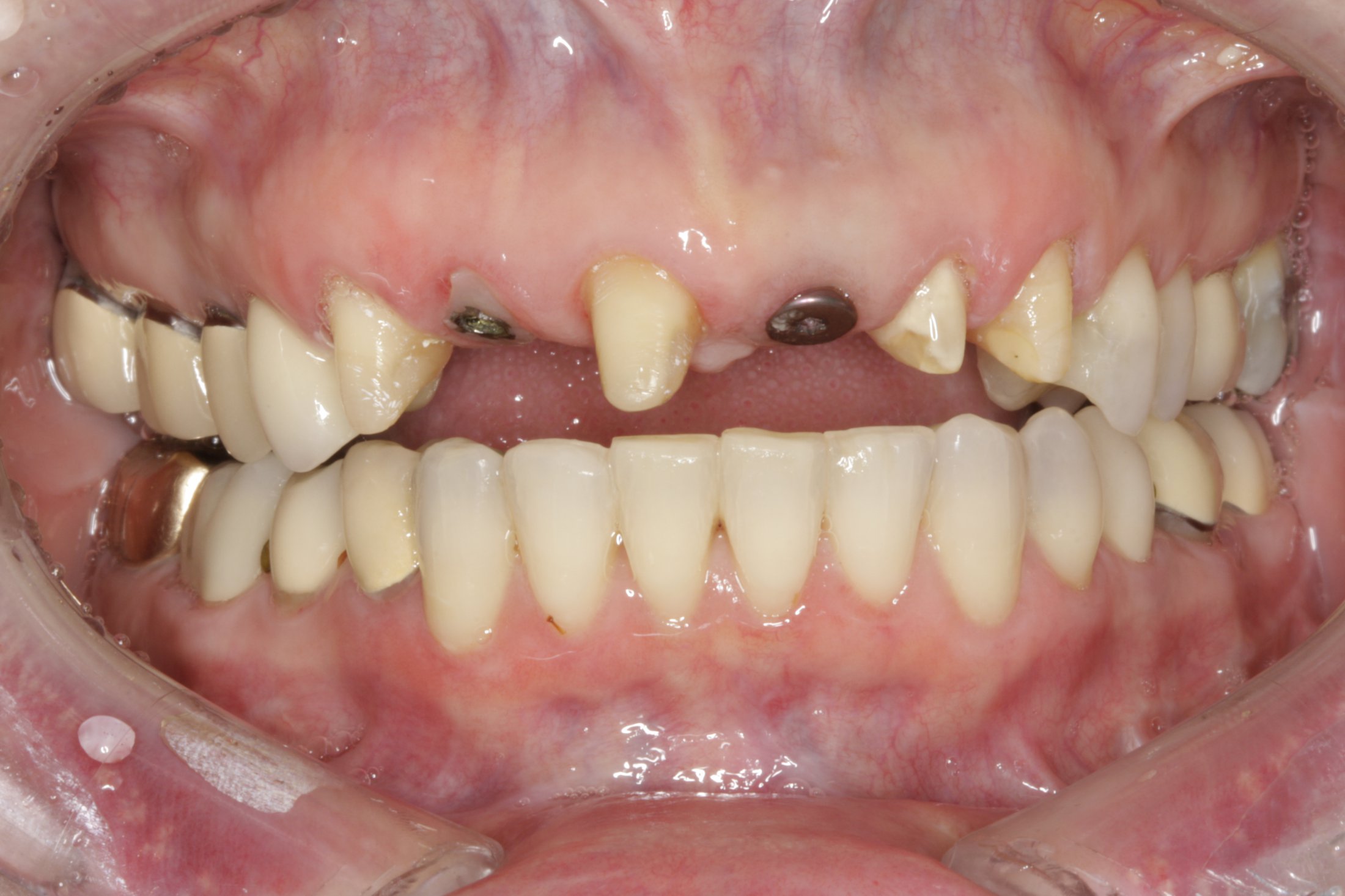 Dental Implants case study