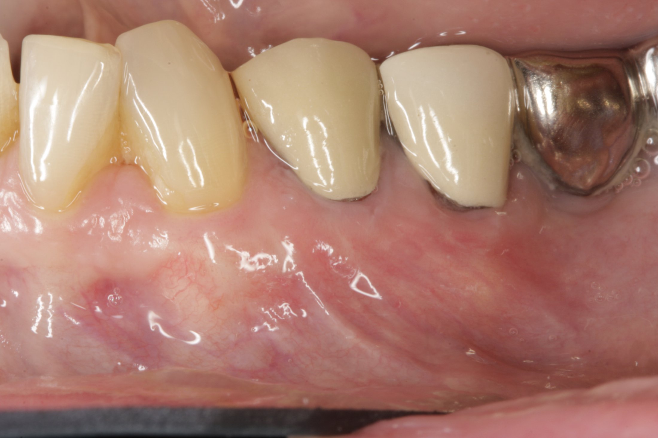 Allograft case study