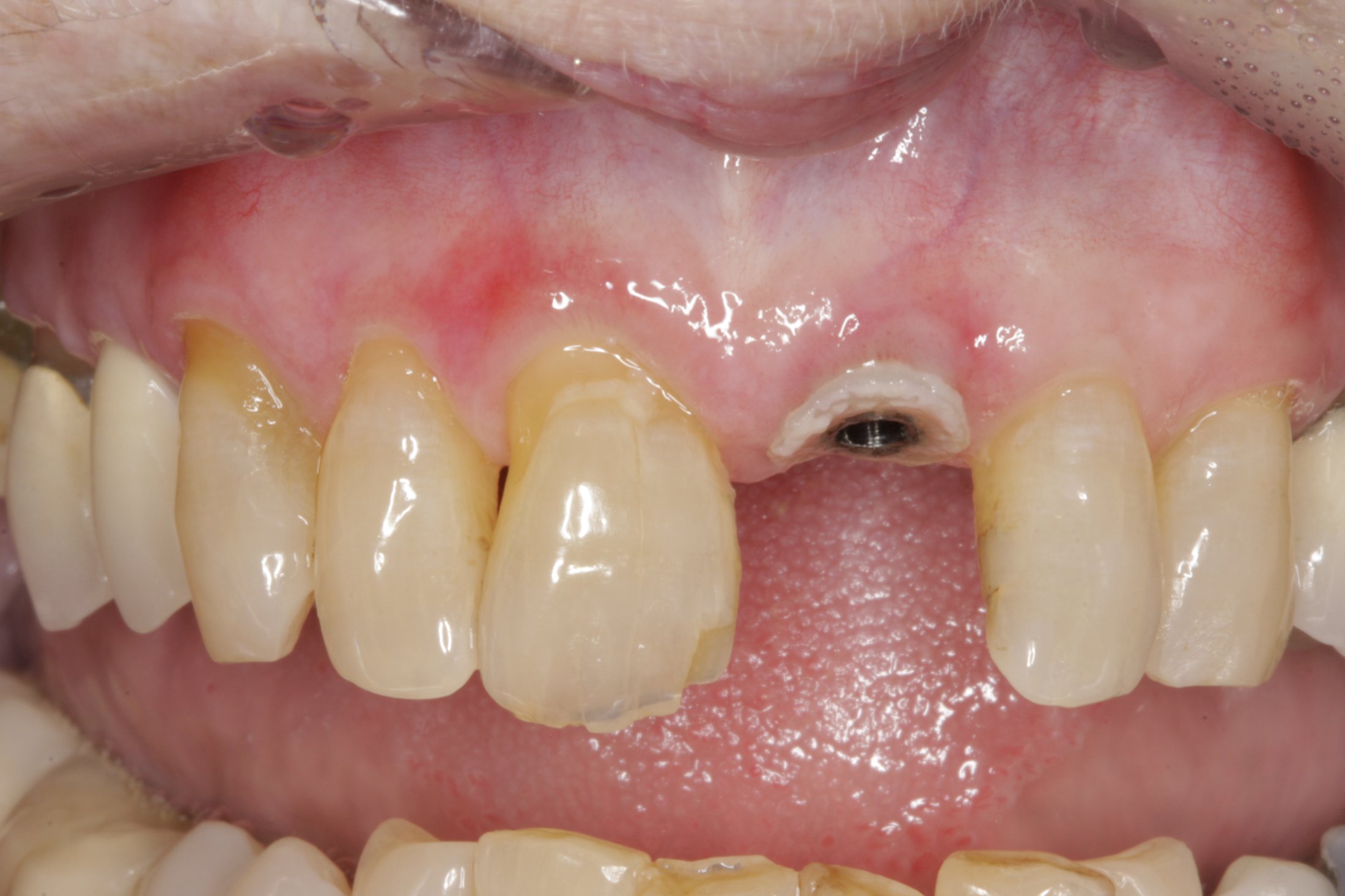 Dental Implants case study