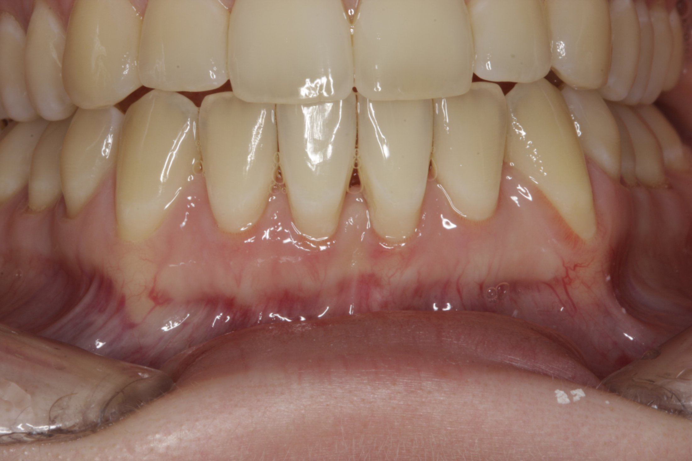 Free Gingival Graft case study