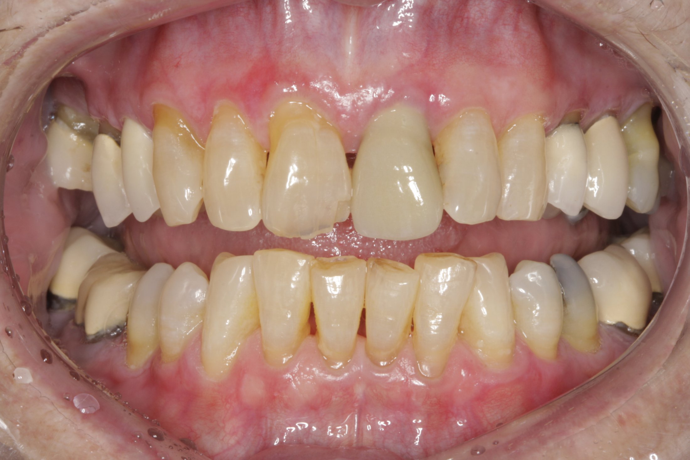 Dental Implants case study
