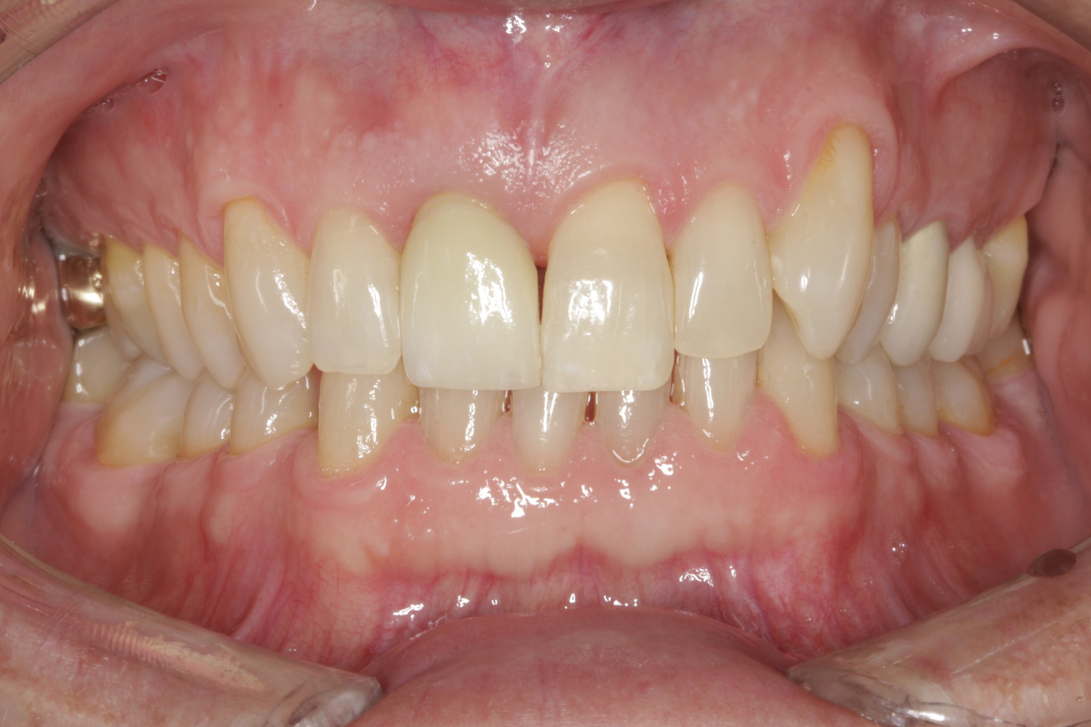 Dental Implants case study