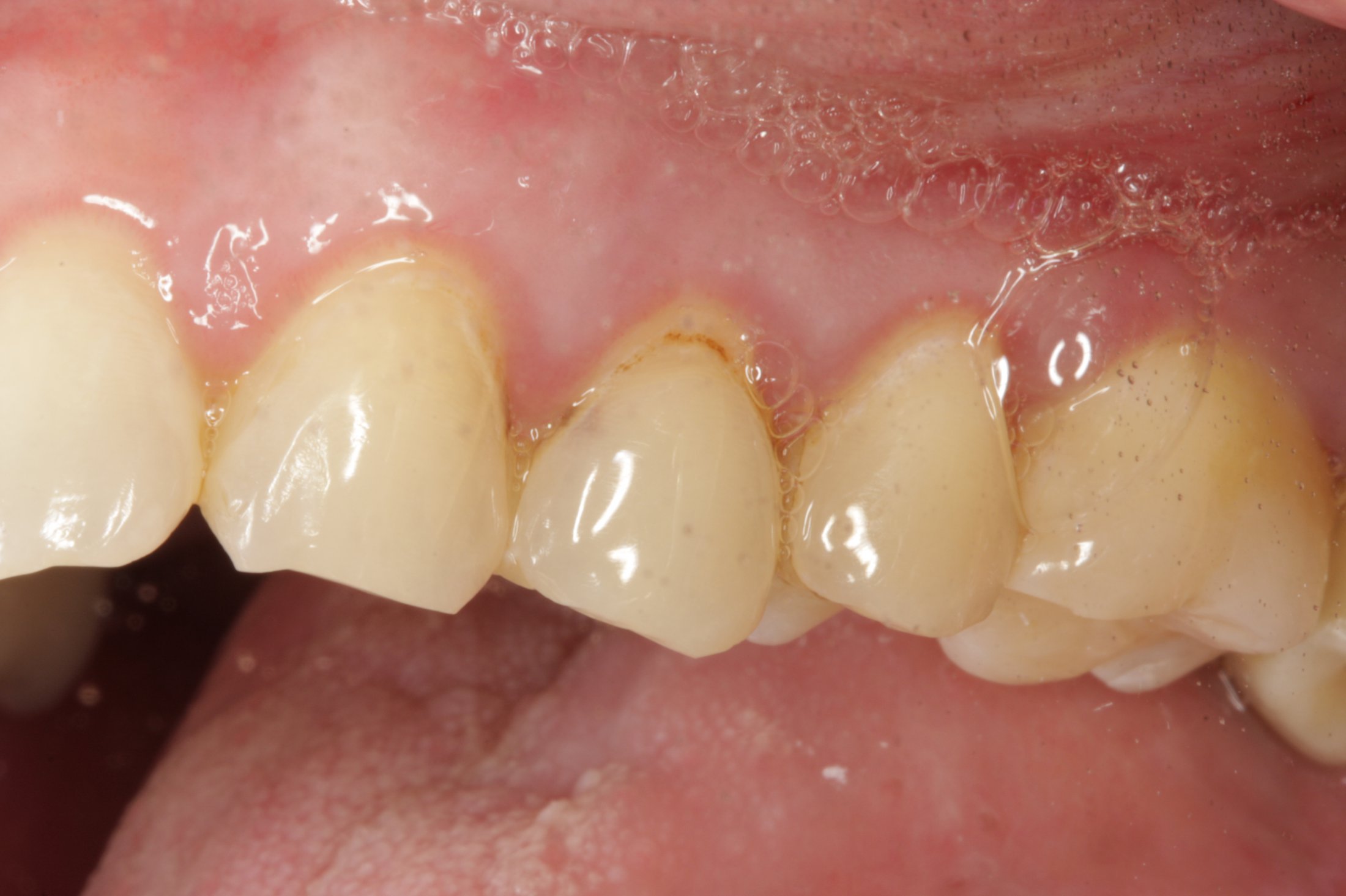 Dental Implants case study