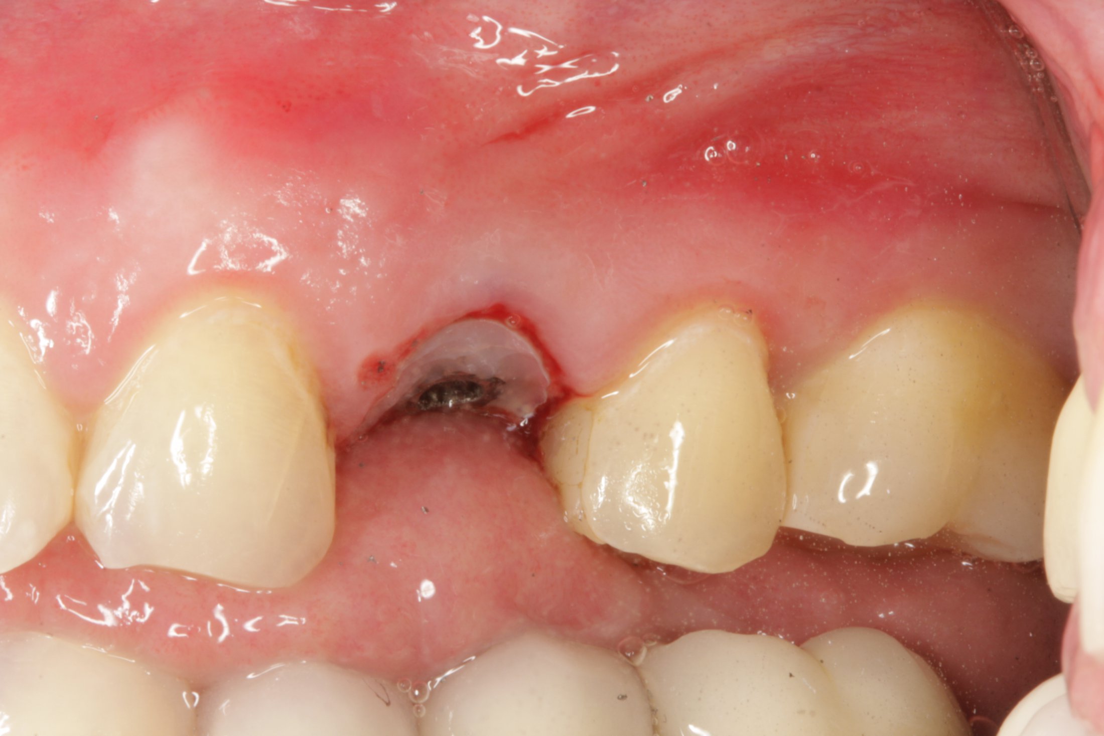 Dental Implants case study