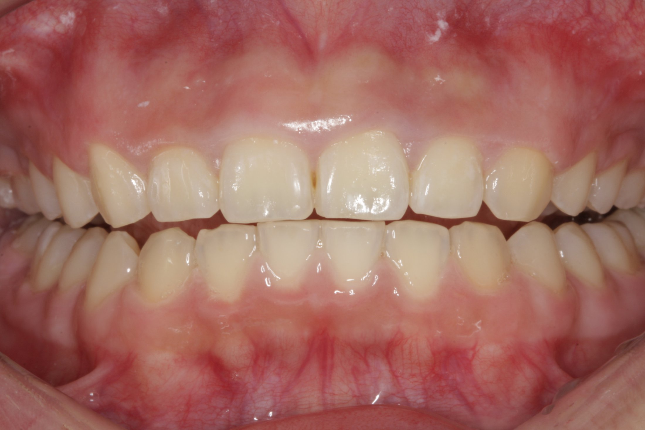 Esthetic Crown Lengthening case study