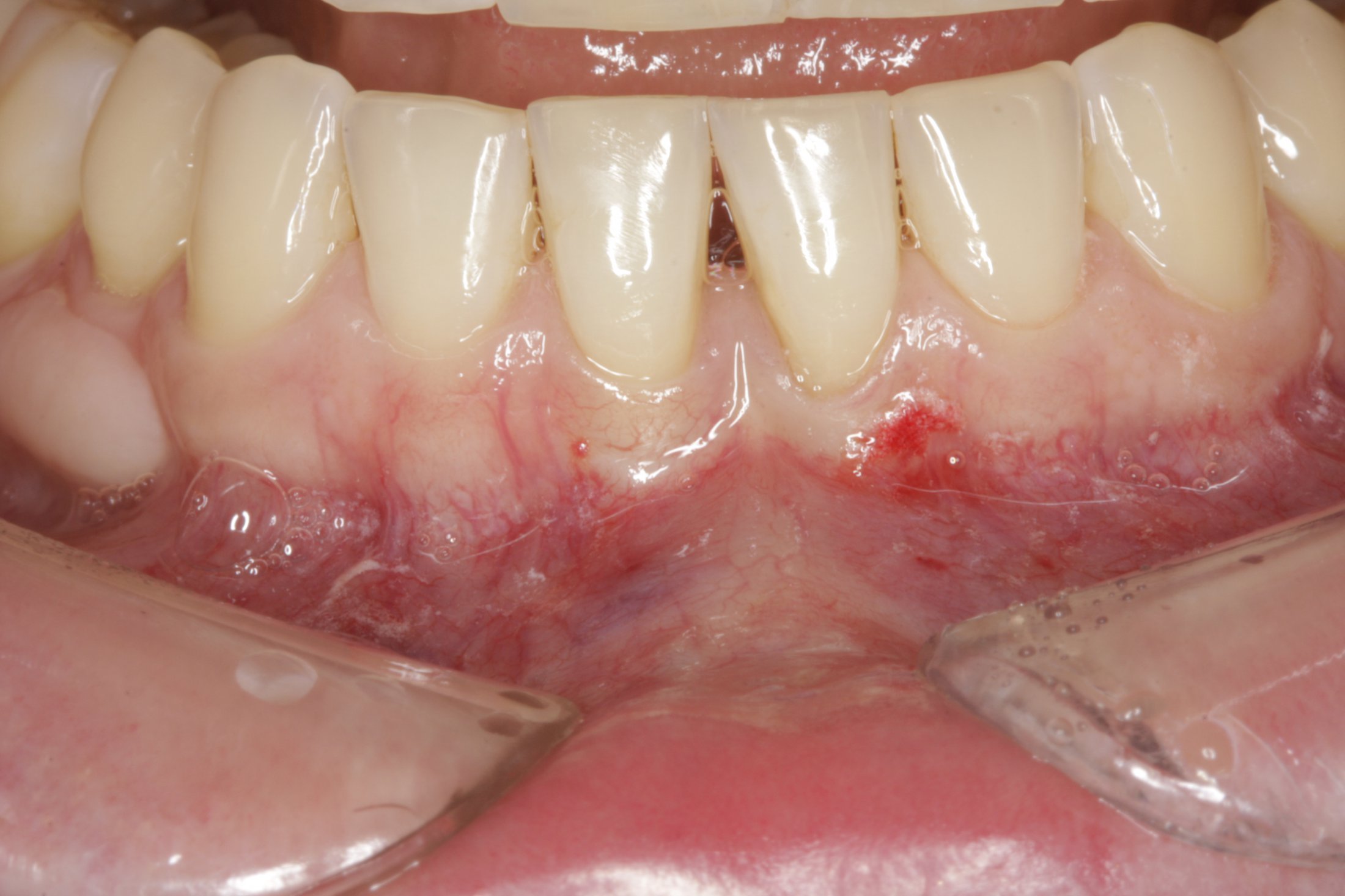 Free Gingival Graft case study