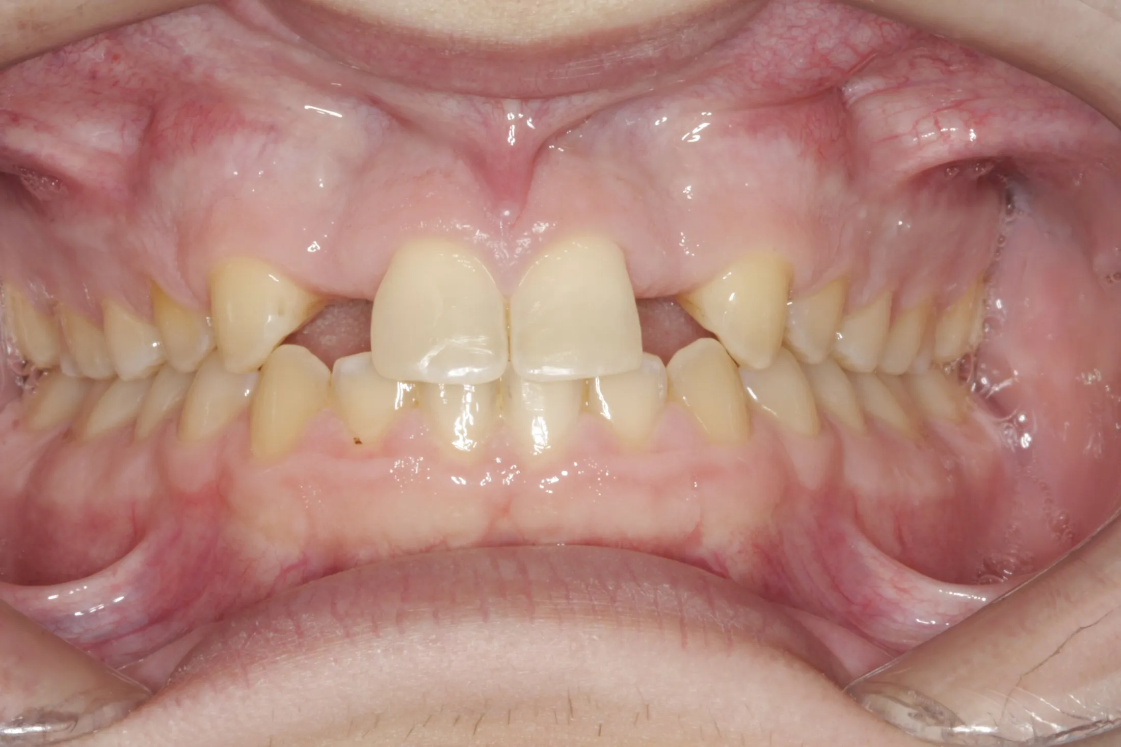 Esthetic Crown Lengthening case study