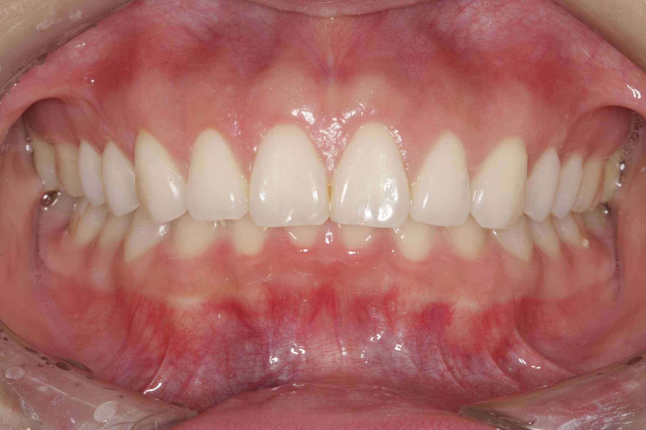Esthetic Crown Lengthening case study