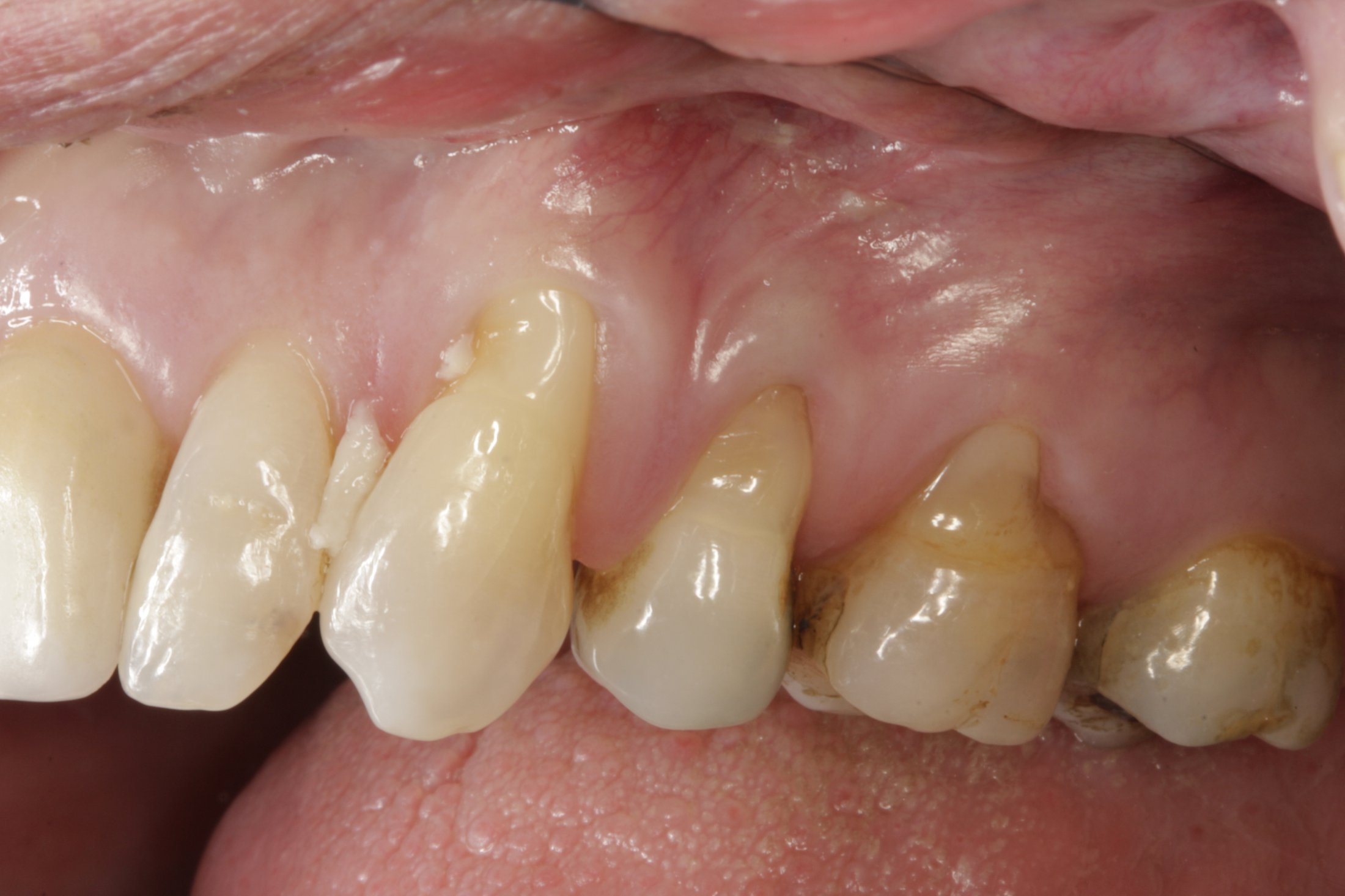 Connective Tissue Graft case study