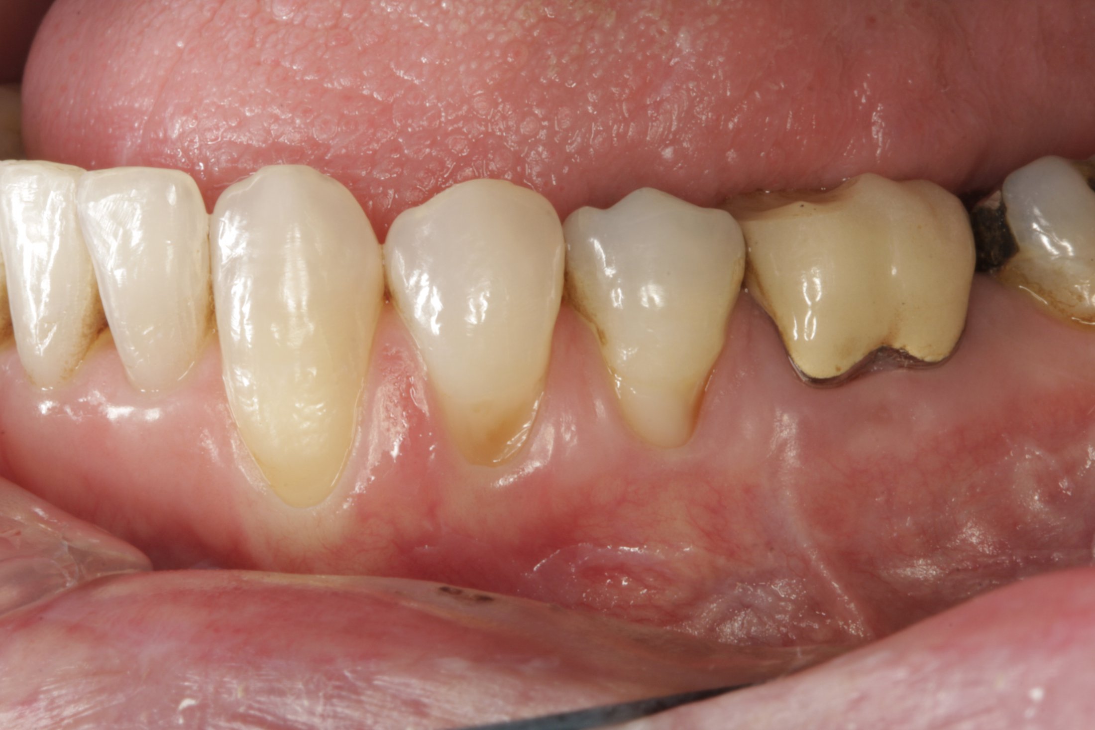 Connective Tissue Graft case study