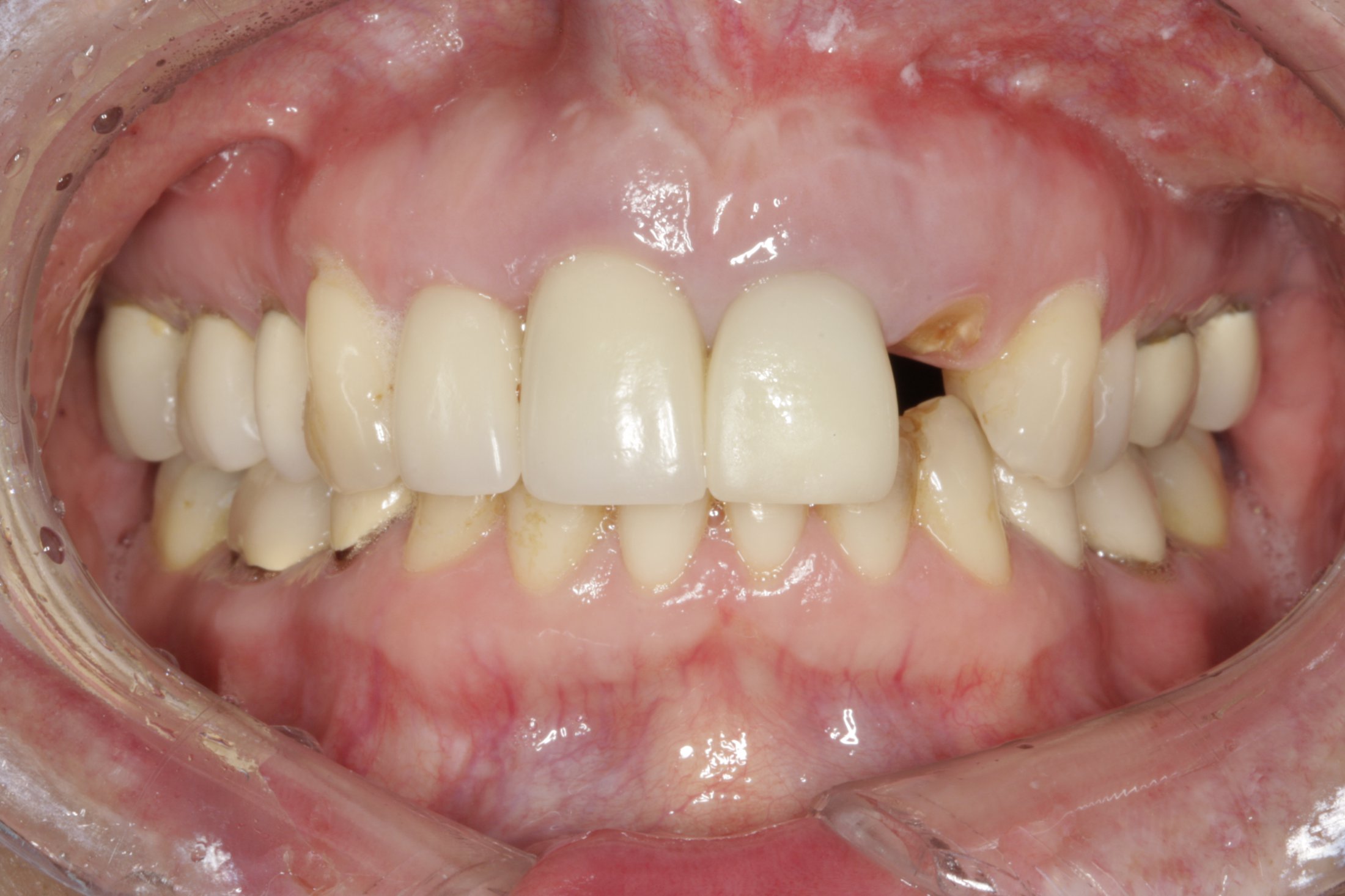 Dental Implants case study