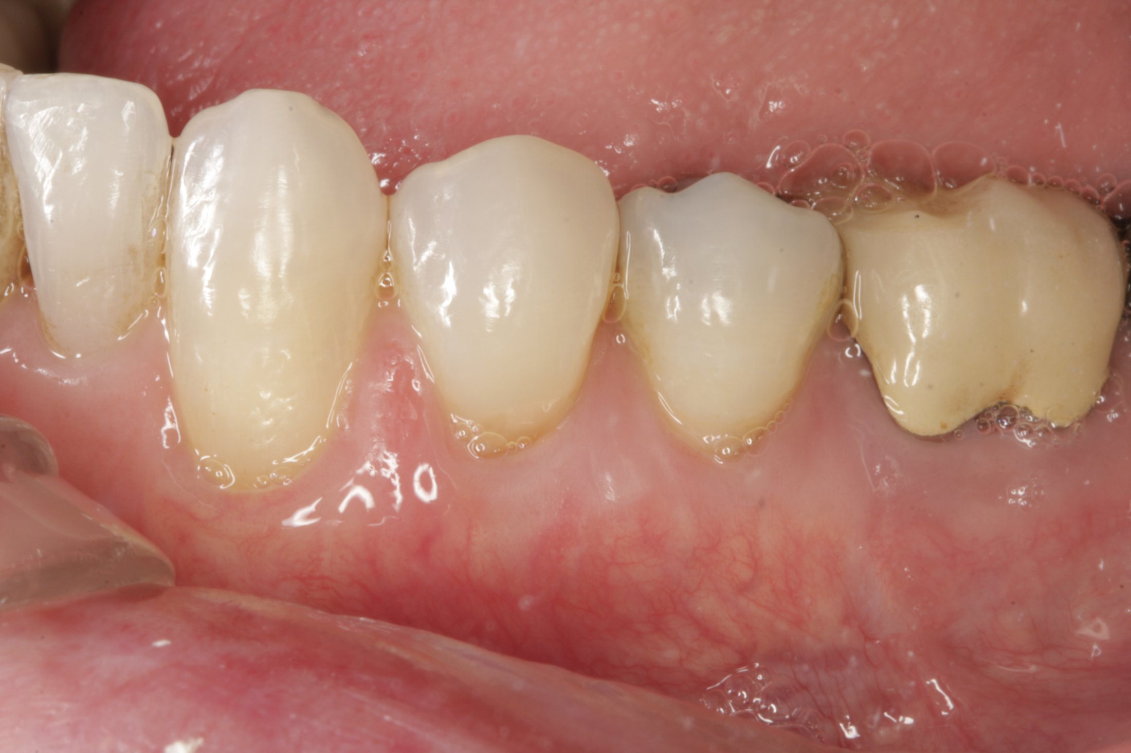 Connective Tissue Graft case study