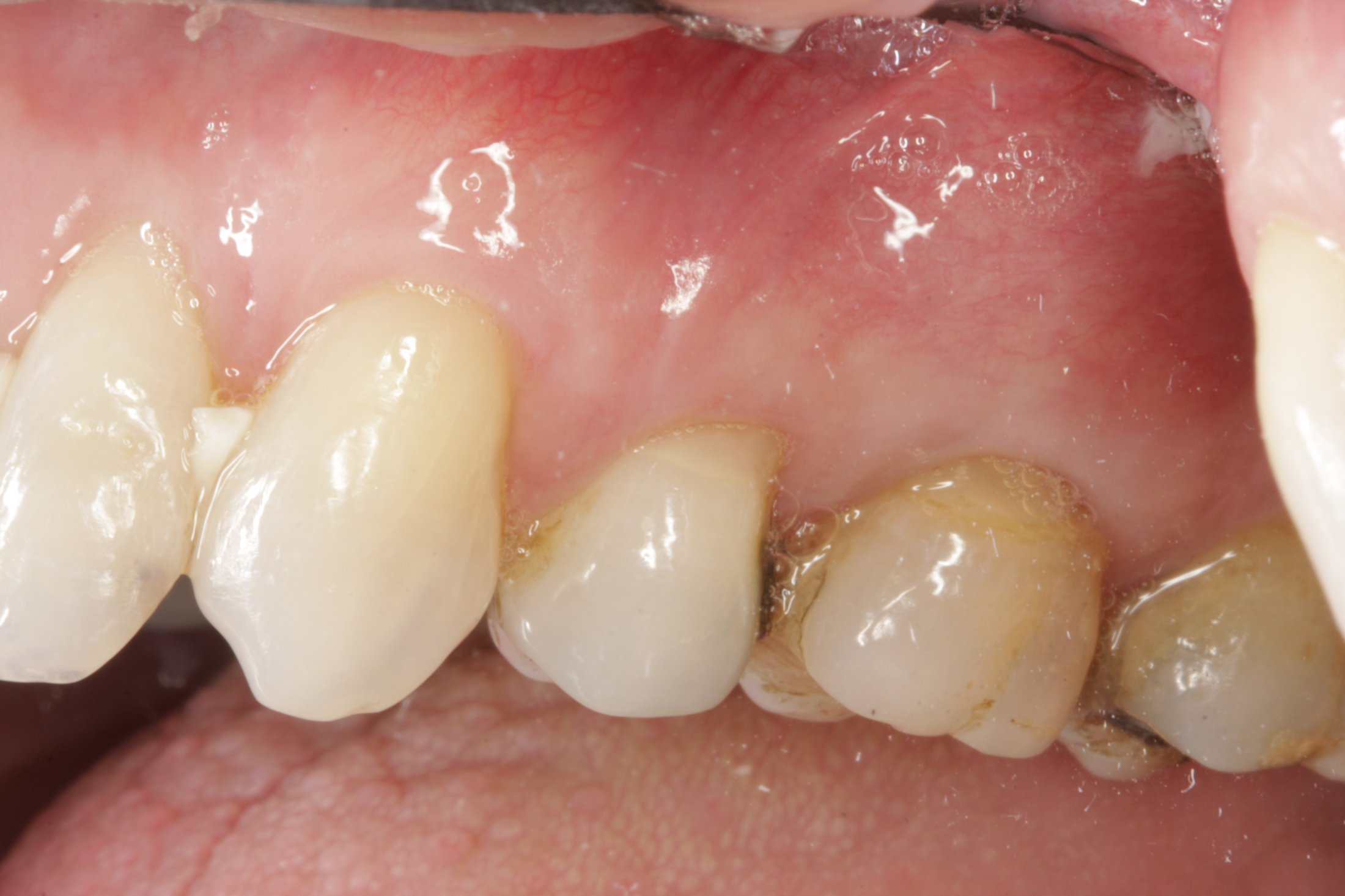 Connective Tissue Graft case study