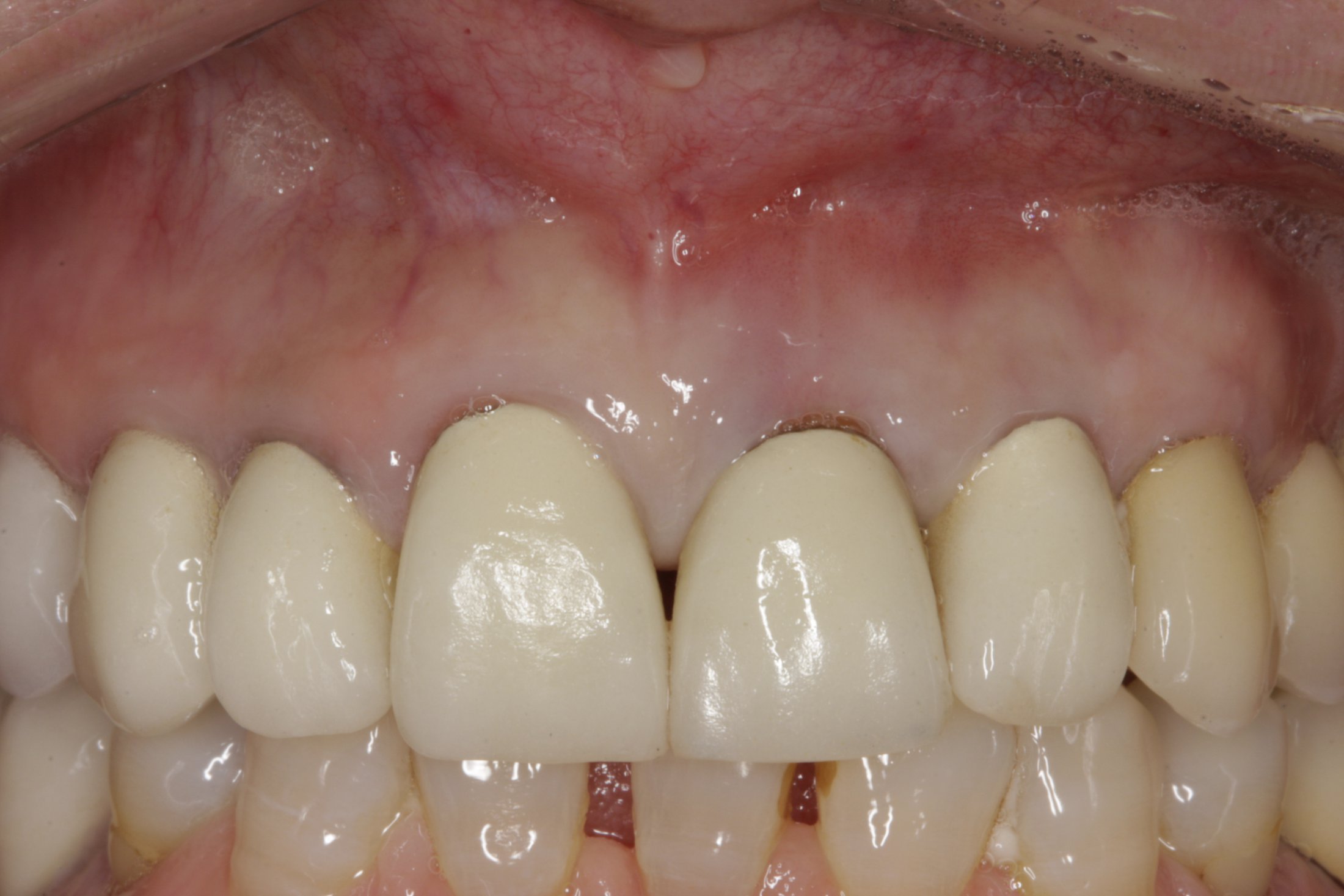 Dental Implants case study