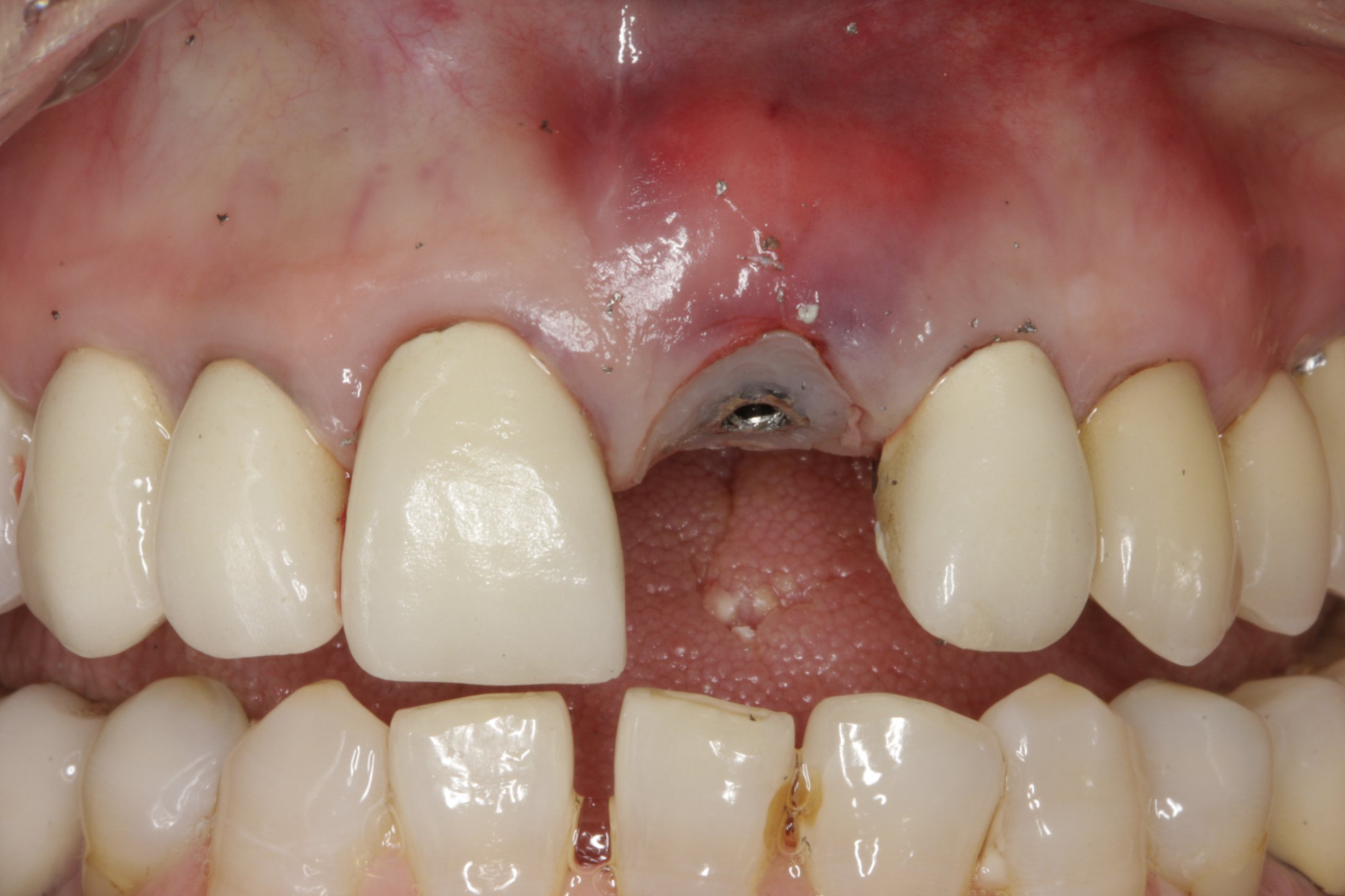 Dental Implants case study