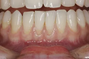 Connective Tissue Graft case study